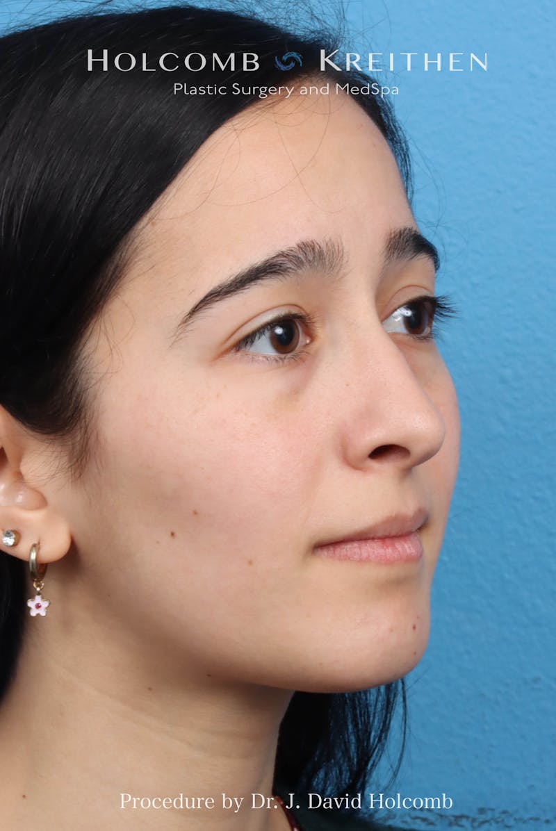 Rhinoplasty Before & After Gallery - Patient 369701 - Image 5