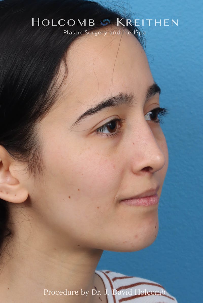 Rhinoplasty Before & After Gallery - Patient 369701 - Image 6