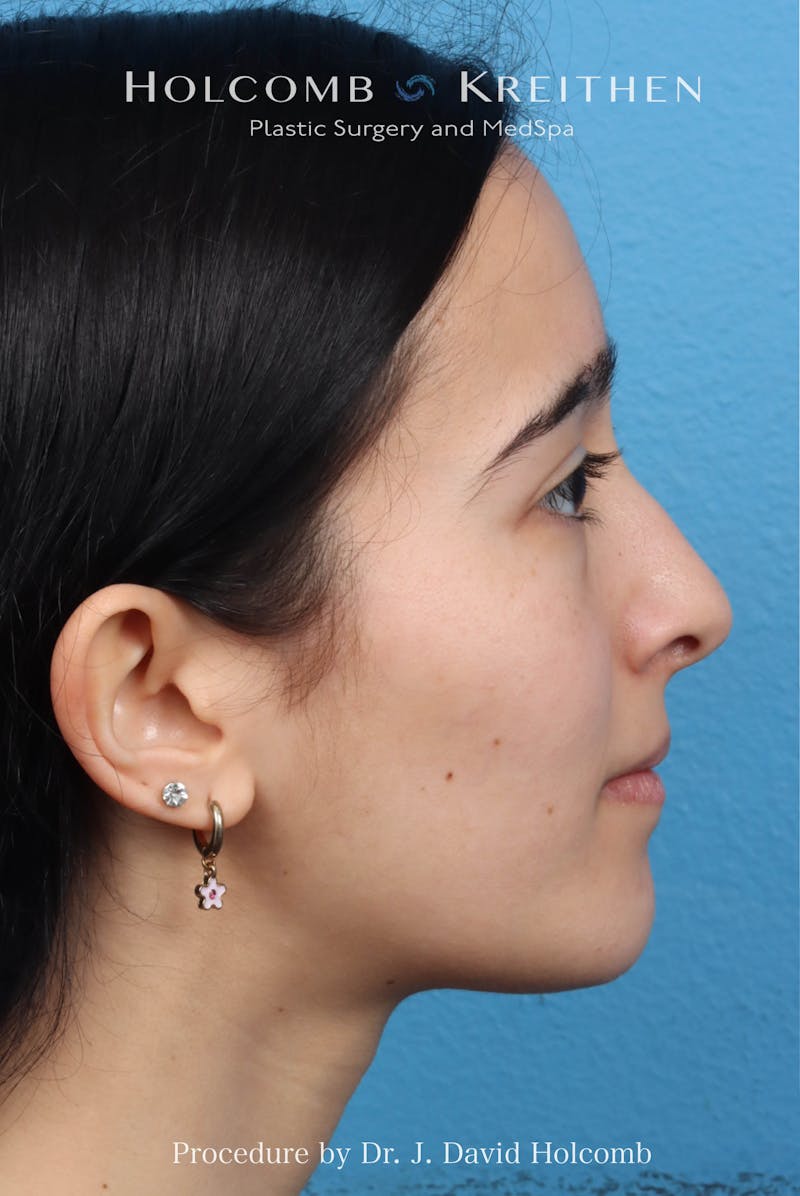 Rhinoplasty Before & After Gallery - Patient 369701 - Image 7