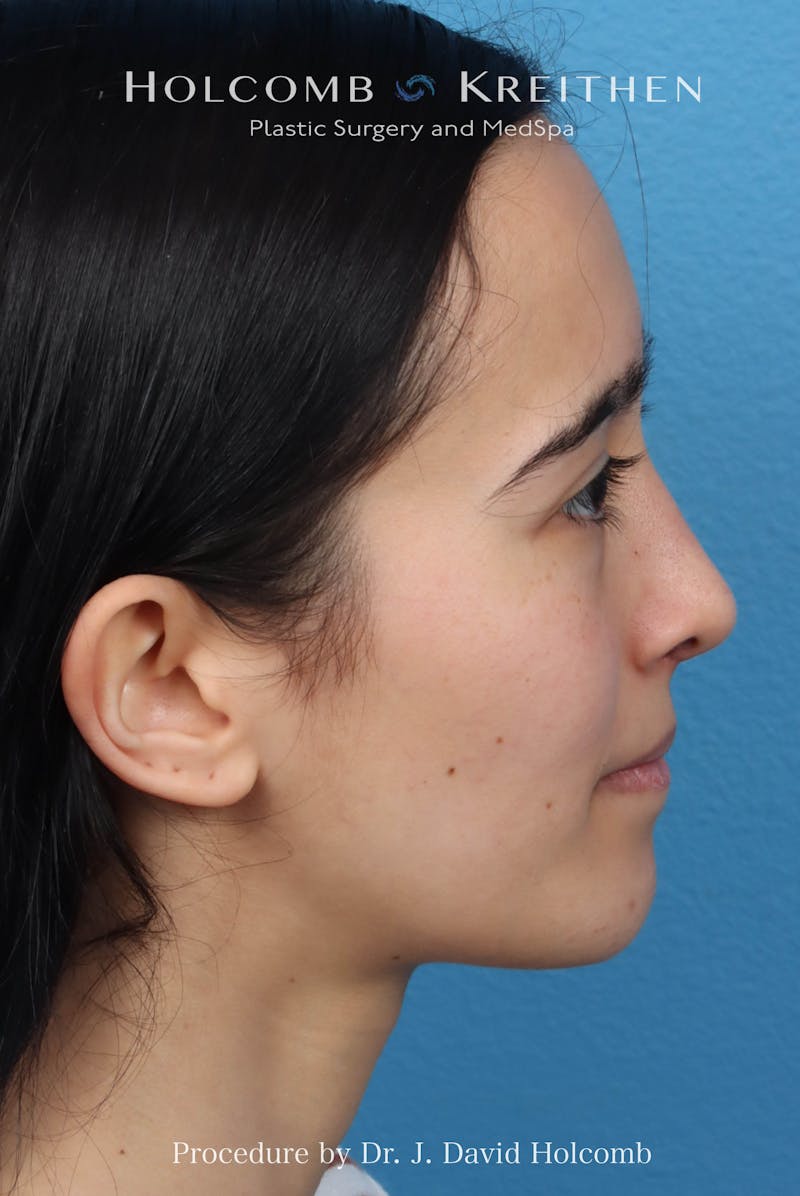 Rhinoplasty Before & After Gallery - Patient 369701 - Image 8