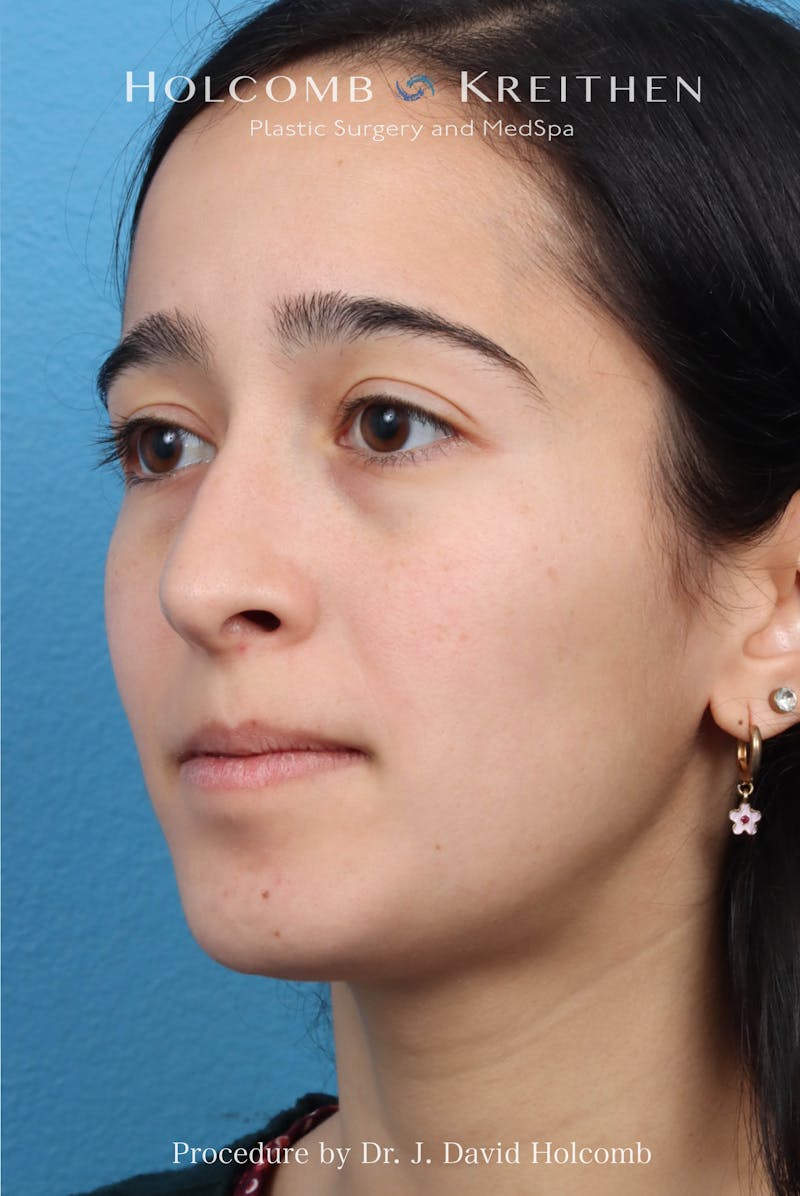 Rhinoplasty Before & After Gallery - Patient 369701 - Image 9