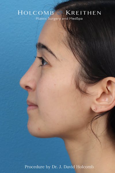 Rhinoplasty Before & After Gallery - Patient 369701 - Image 2