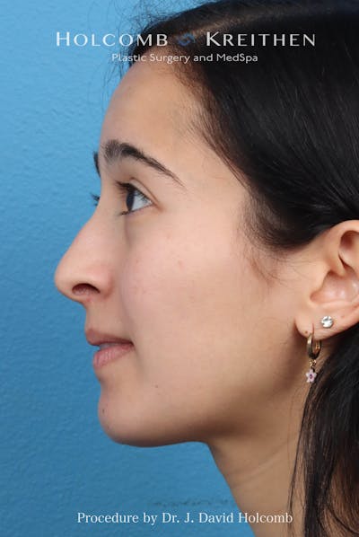 Rhinoplasty Before & After Gallery - Patient 369701 - Image 1