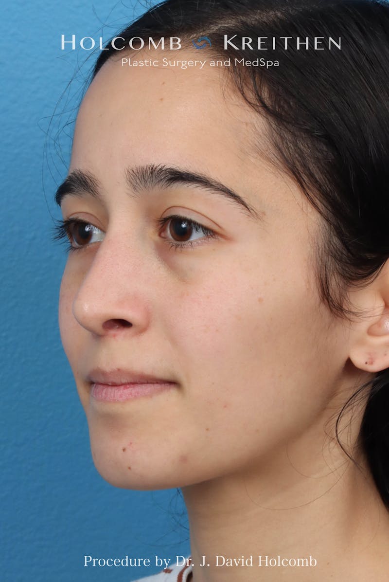 Rhinoplasty Before & After Gallery - Patient 369701 - Image 10