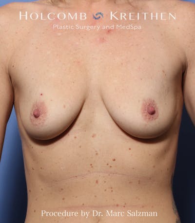 Breast Augmentation Before & After Gallery - Patient 428684 - Image 1