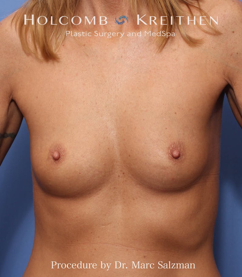 Breast Augmentation Before & After Gallery - Patient 703386 - Image 1
