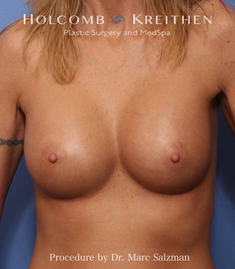 Breast Augmentation Before & After Gallery - Patient 703386 - Image 2