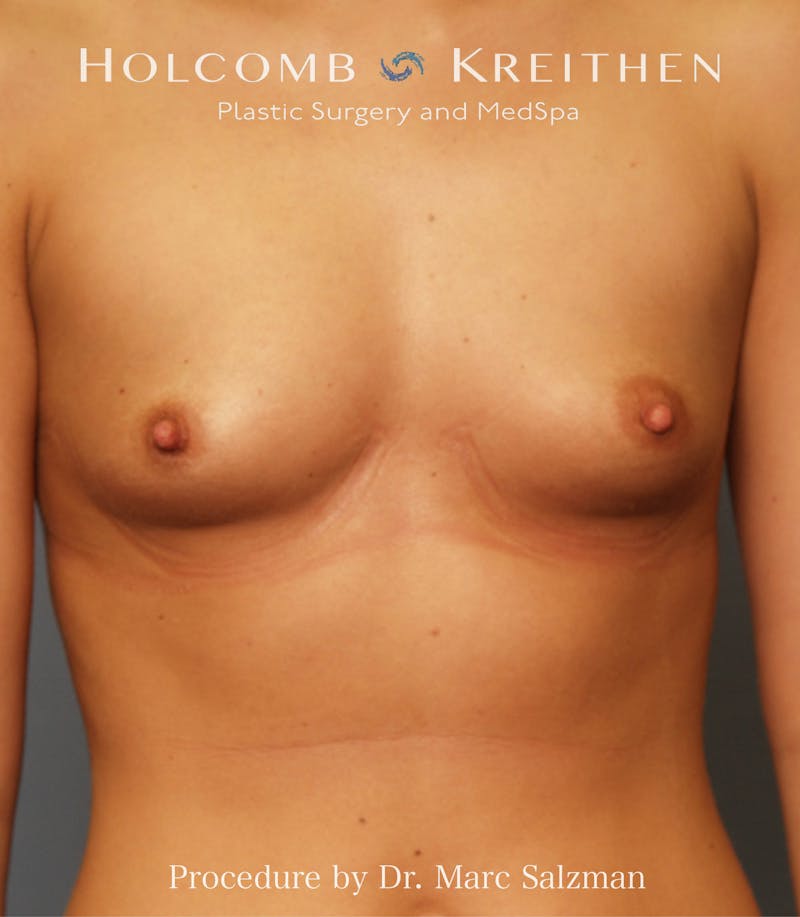 Breast Augmentation Before & After Gallery - Patient 831301 - Image 1