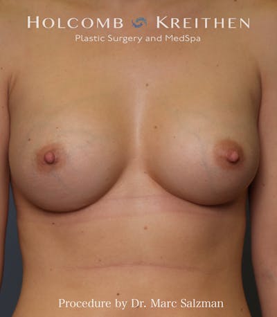 Breast Augmentation Before & After Gallery - Patient 831301 - Image 2