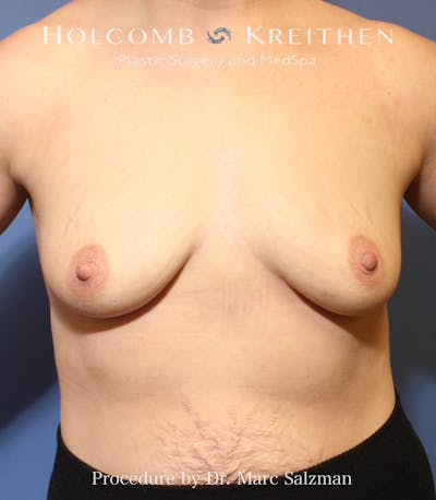 Breast Augmentation Before & After Gallery - Patient 182069 - Image 1