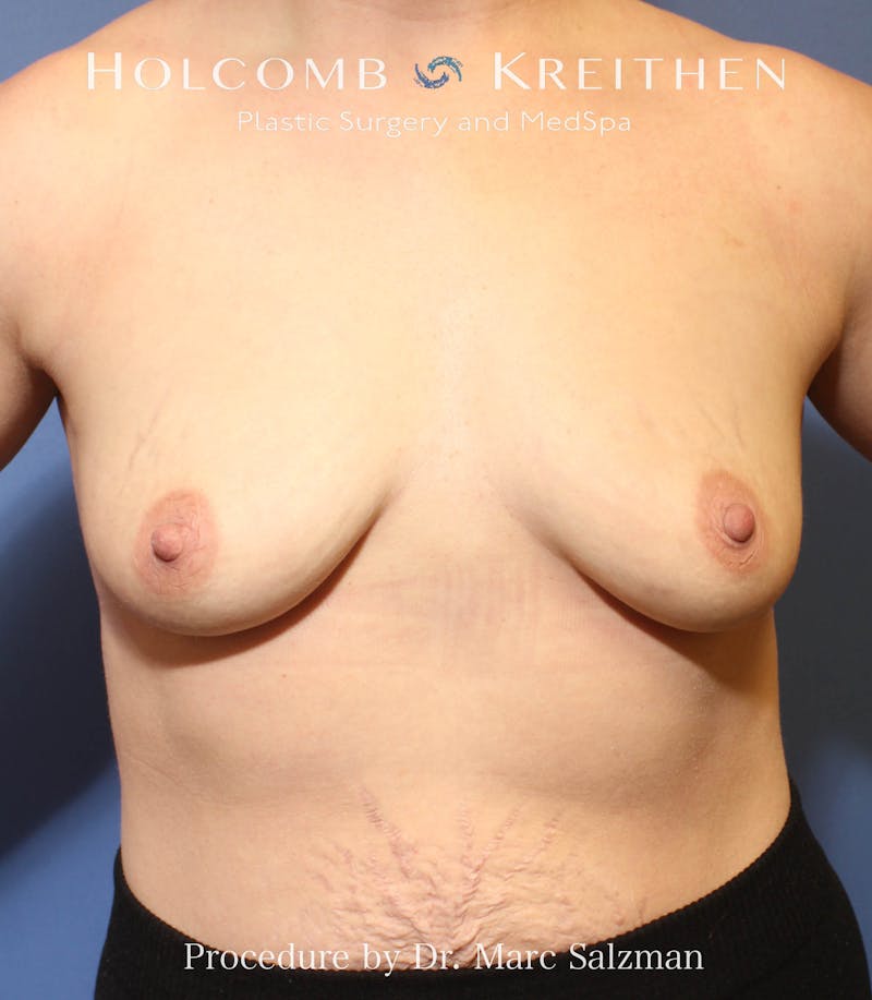 Breast Augmentation Before & After Gallery - Patient 182069 - Image 1