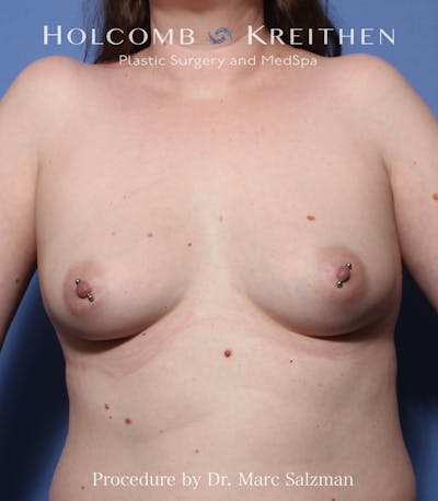 Breast Augmentation Before & After Gallery - Patient 272840 - Image 1