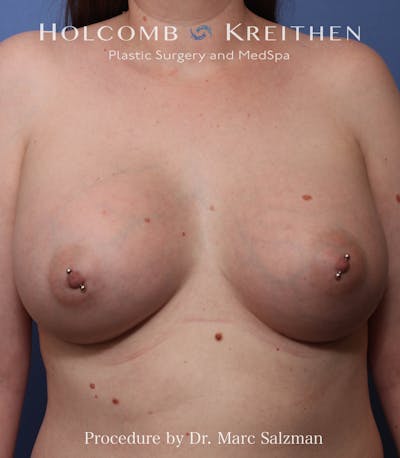 Breast Augmentation Before & After Gallery - Patient 272840 - Image 2