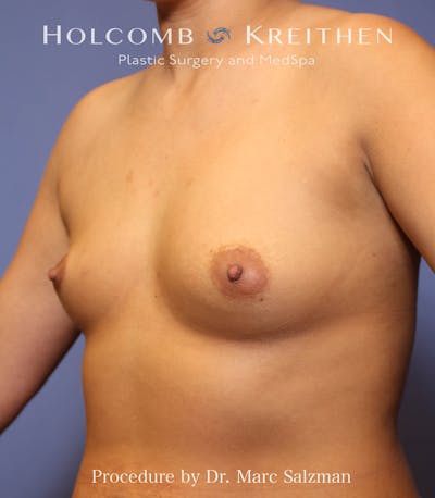 Breast Augmentation Before & After Gallery - Patient 190943 - Image 1
