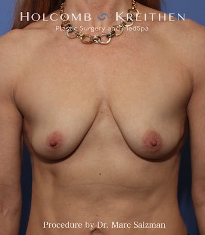 Breast Augmentation & Lift Before & After Gallery - Patient 394633 - Image 1