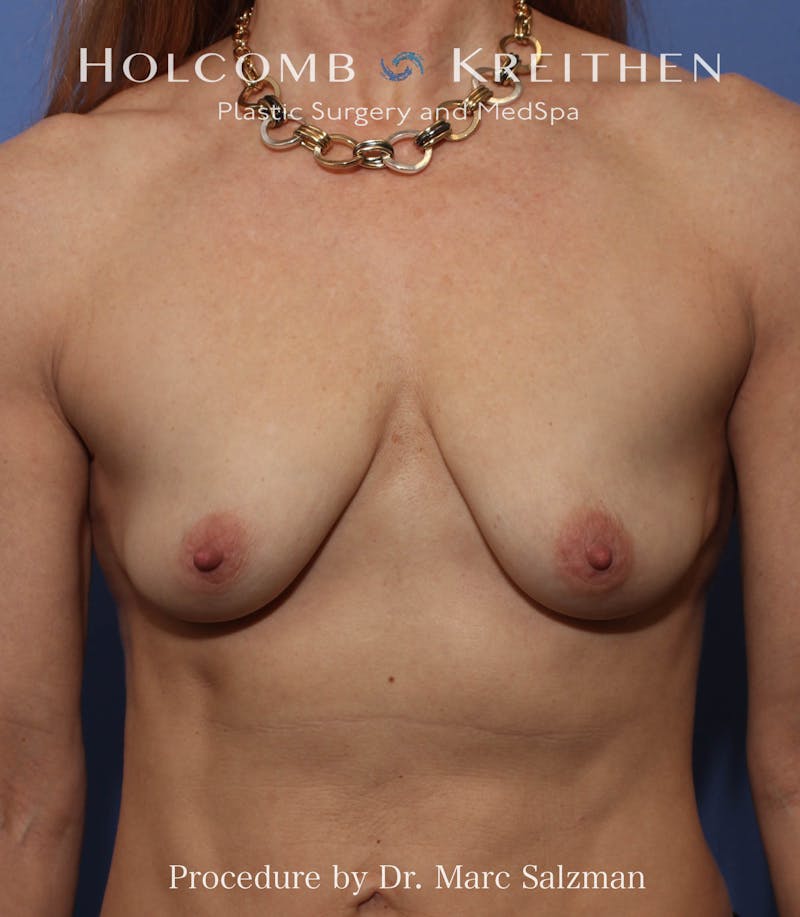 Breast Augmentation & Lift Before & After Gallery - Patient 394633 - Image 1