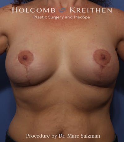 Breast Augmentation & Lift Before & After Gallery - Patient 408851 - Image 2