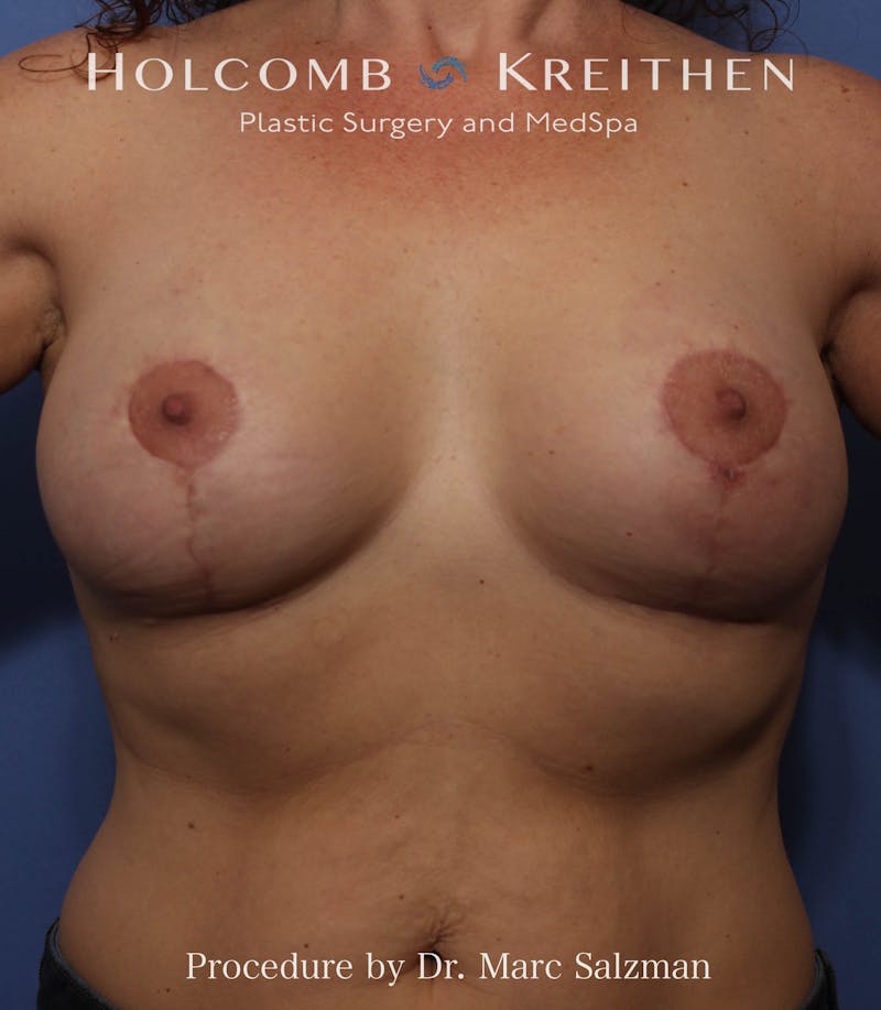 Breast Augmentation & Lift Before & After Gallery - Patient 408851 - Image 2