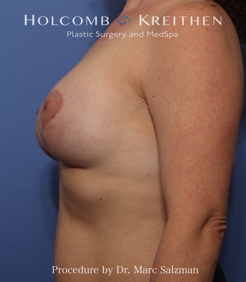 Breast Augmentation & Lift Before & After Gallery - Patient 408851 - Image 4