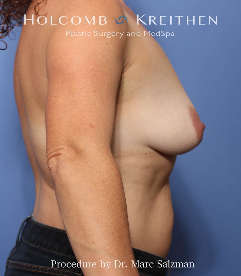 Breast Augmentation & Lift Before & After Gallery - Patient 408851 - Image 5