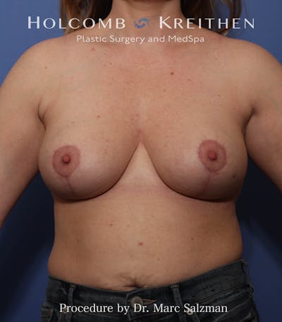 Breast Augmentation & Lift Before & After Gallery - Patient 153294 - Image 2