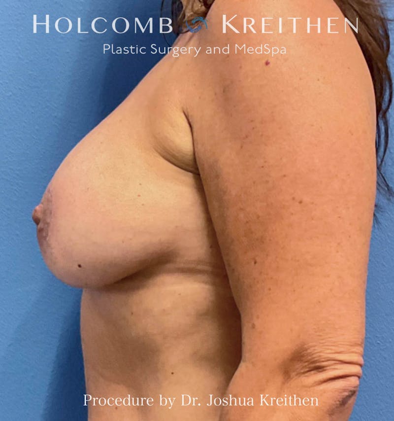 Breast Augmentation & Lift Before & After Gallery - Patient 725494 - Image 4