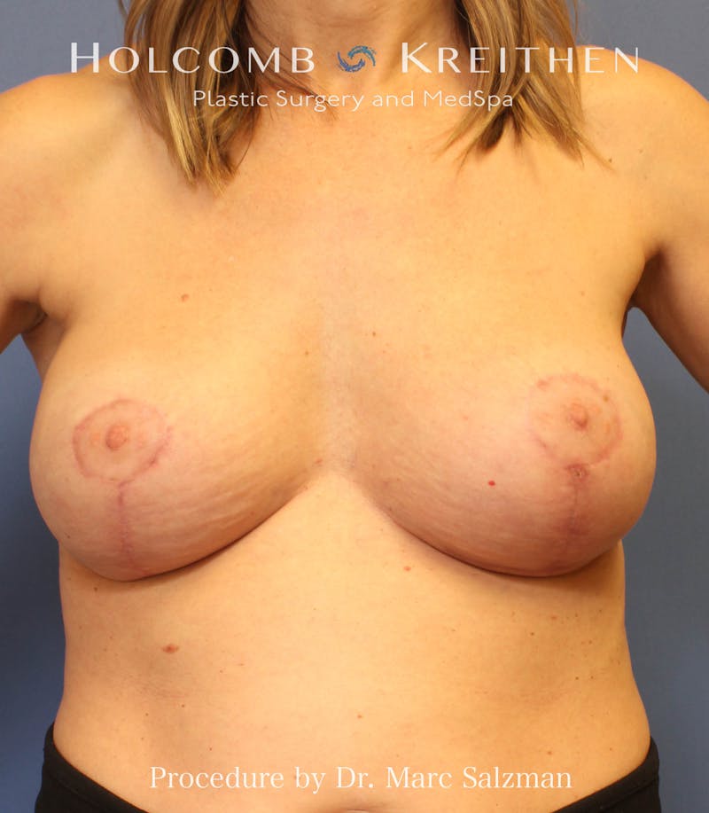 Breast Augmentation & Lift Before & After Gallery - Patient 234108 - Image 2