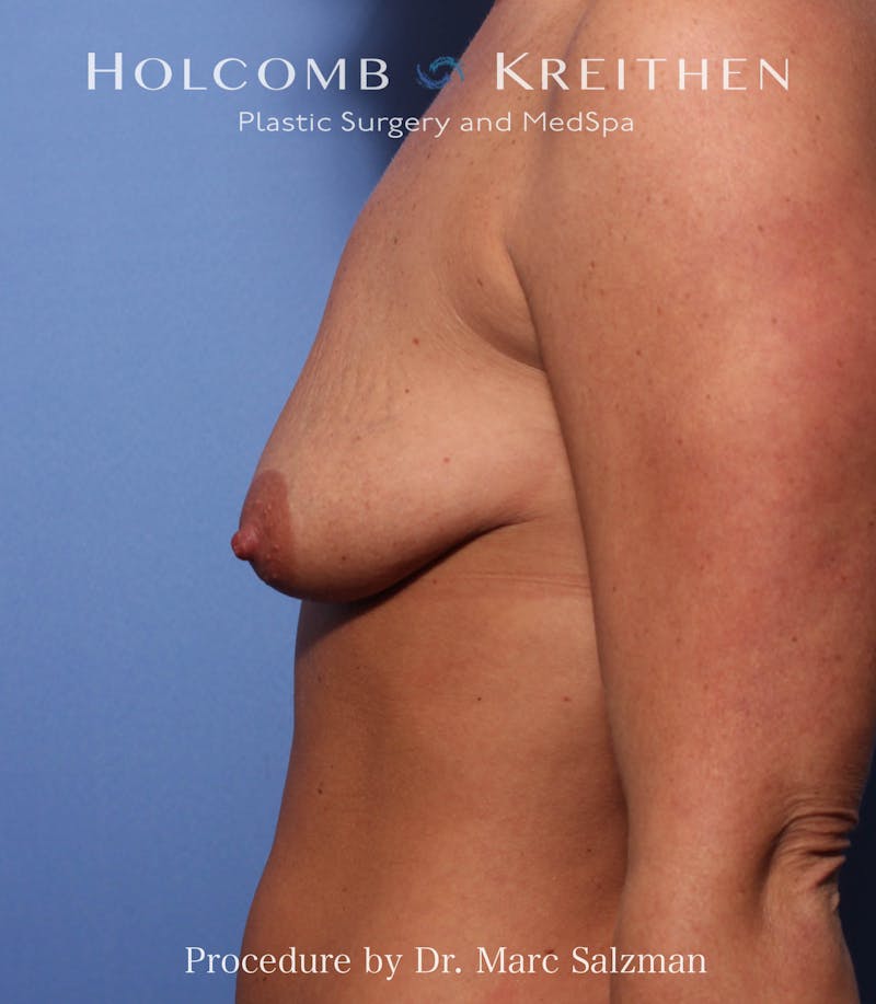 Breast Augmentation & Lift Before & After Gallery - Patient 402594 - Image 1