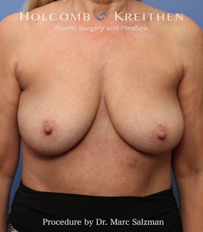Breast Augmentation & Lift Before & After Gallery - Patient 263758 - Image 1