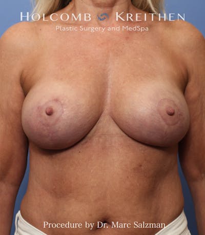 Breast Augmentation & Lift Before & After Gallery - Patient 263758 - Image 2