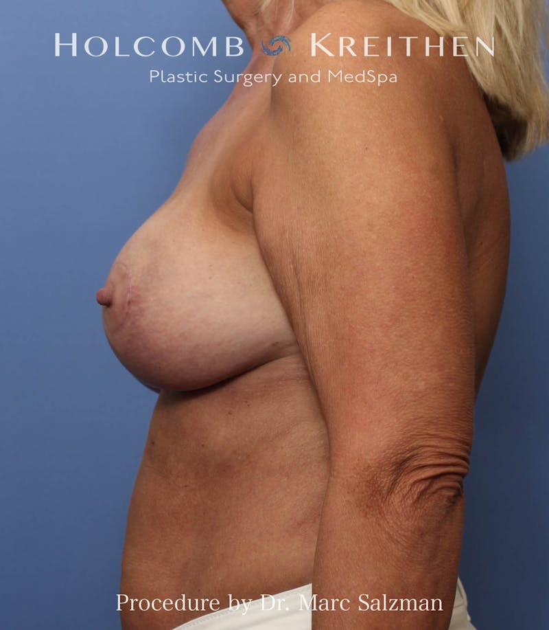 Breast Augmentation & Lift Before & After Gallery - Patient 263758 - Image 4
