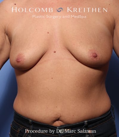 Breast Augmentation & Lift Before & After Gallery - Patient 725062 - Image 1