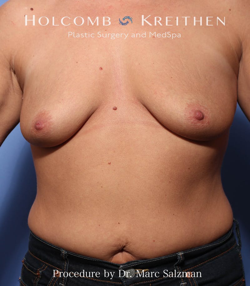 Breast Augmentation & Lift Before & After Gallery - Patient 725062 - Image 1