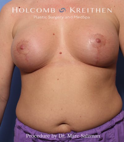 Breast Augmentation & Lift Before & After Gallery - Patient 725062 - Image 2