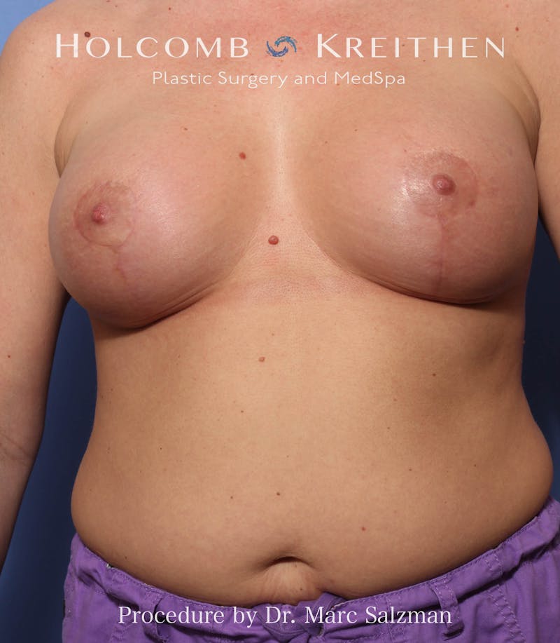 Breast Augmentation & Lift Before & After Gallery - Patient 725062 - Image 2