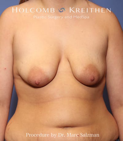Breast Augmentation & Lift Before & After Gallery - Patient 383442 - Image 1