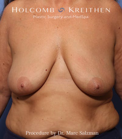 Breast Augmentation & Lift Before & After Gallery - Patient 265306 - Image 1