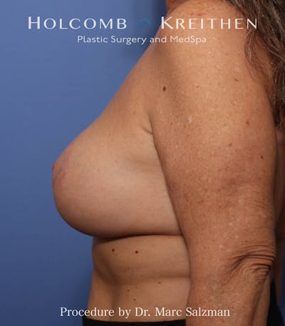 Breast Augmentation & Lift Before & After Gallery - Patient 265306 - Image 2