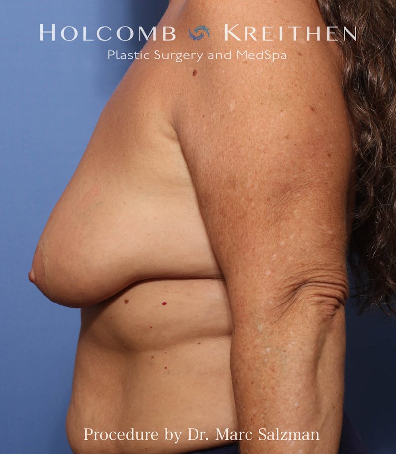 Breast Augmentation & Lift Before & After Gallery - Patient 265306 - Image 3