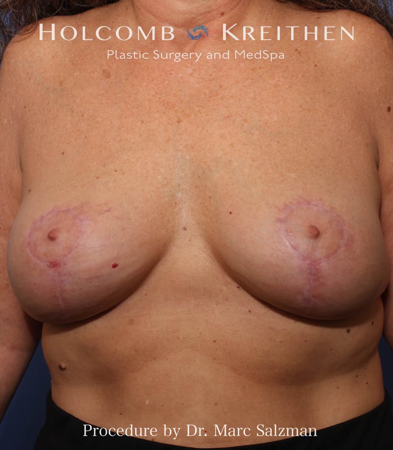 Breast Augmentation & Lift Before & After Gallery - Patient 265306 - Image 4