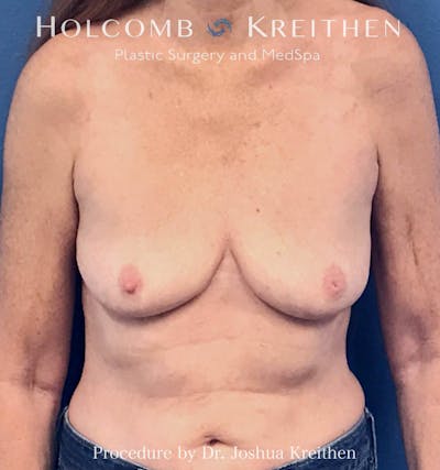 Breast Explant Before & After Gallery - Patient 289694 - Image 2