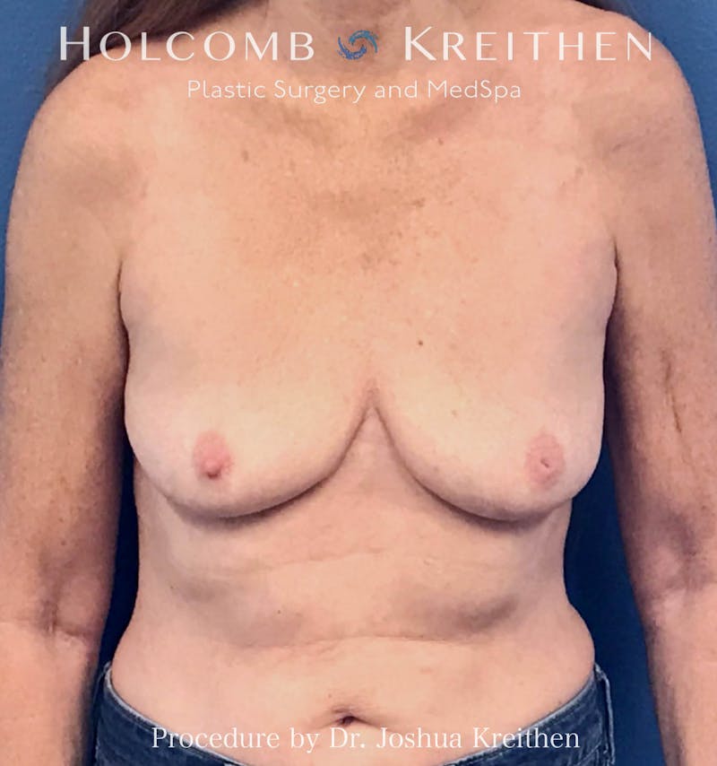 Breast Explant Before & After Gallery - Patient 289694 - Image 2