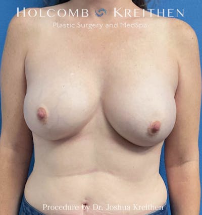 Breast Explant Before & After Gallery - Patient 317378 - Image 1