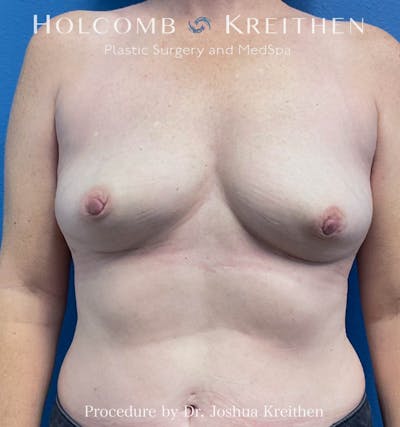 Breast Explant Before & After Gallery - Patient 317378 - Image 2