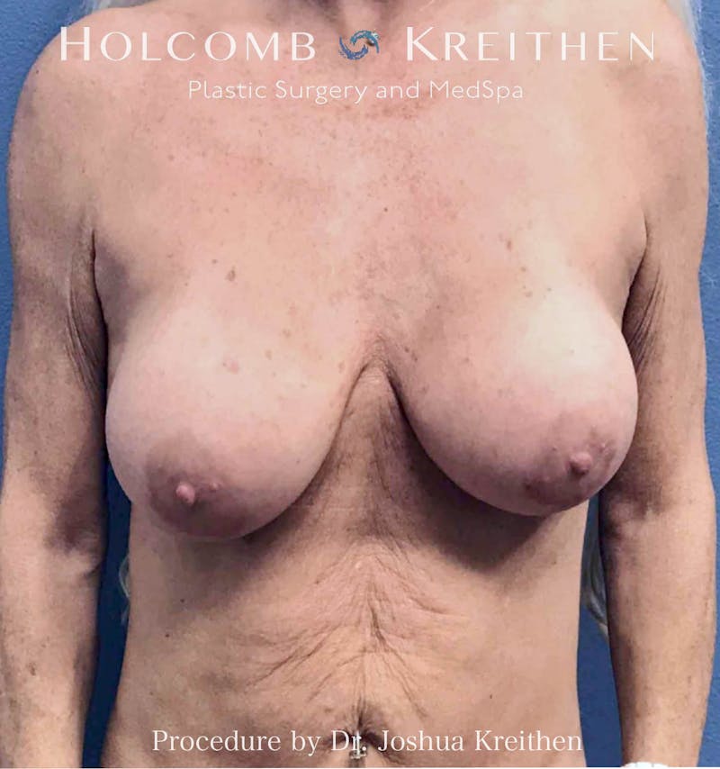 Breast Lift Before & After Gallery - Patient 330332 - Image 1
