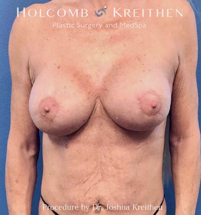 Breast Lift Before & After Gallery - Patient 330332 - Image 2