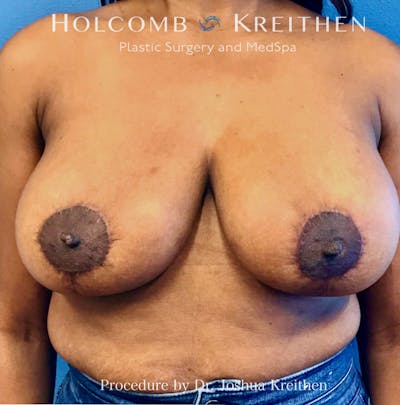 Breast Reduction Before & After Gallery - Patient 313637 - Image 2