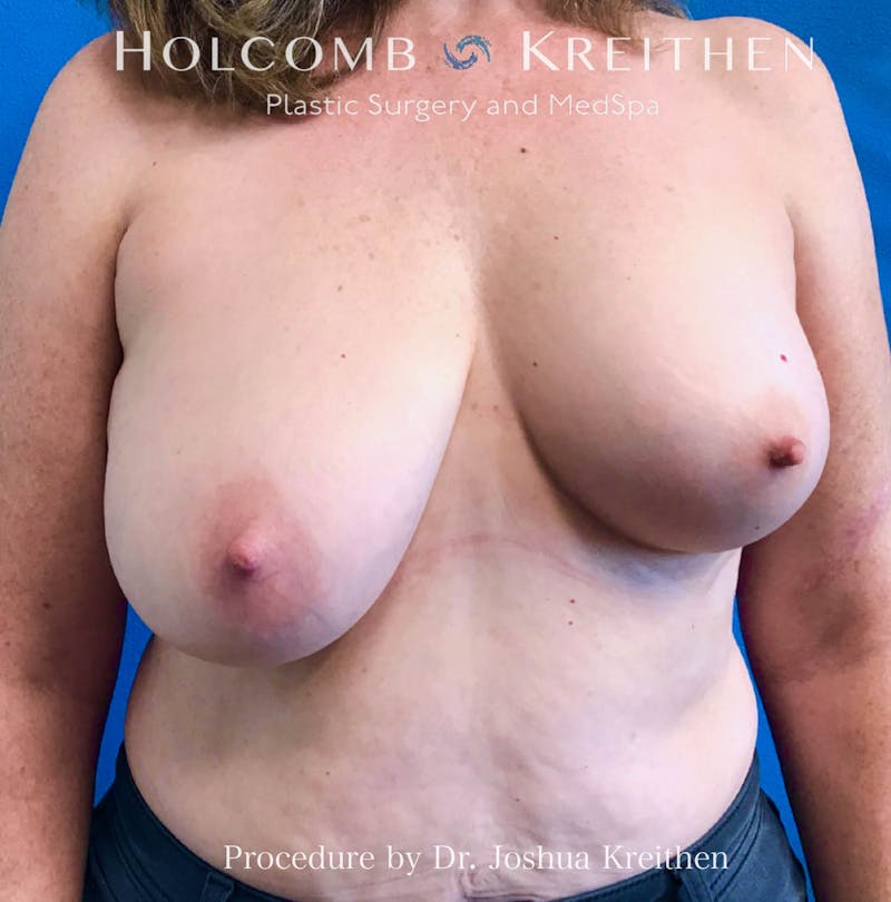 Breast Reduction Before & After Gallery - Patient 358072 - Image 1