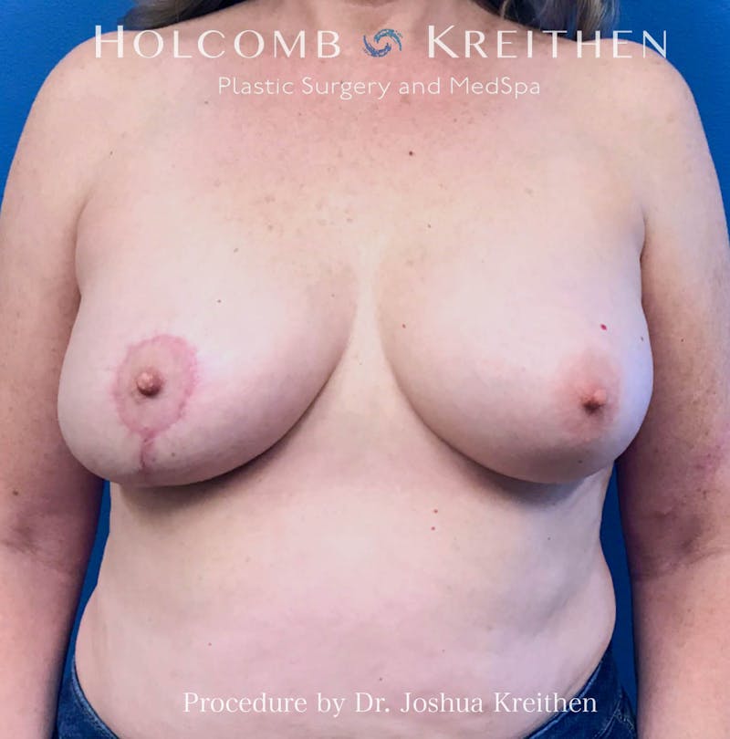 Breast Reduction Before & After Gallery - Patient 358072 - Image 2