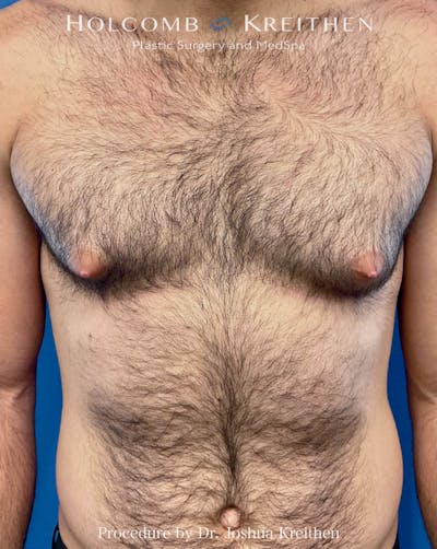 Gynecomastia Before & After Gallery - Patient 582395 - Image 1